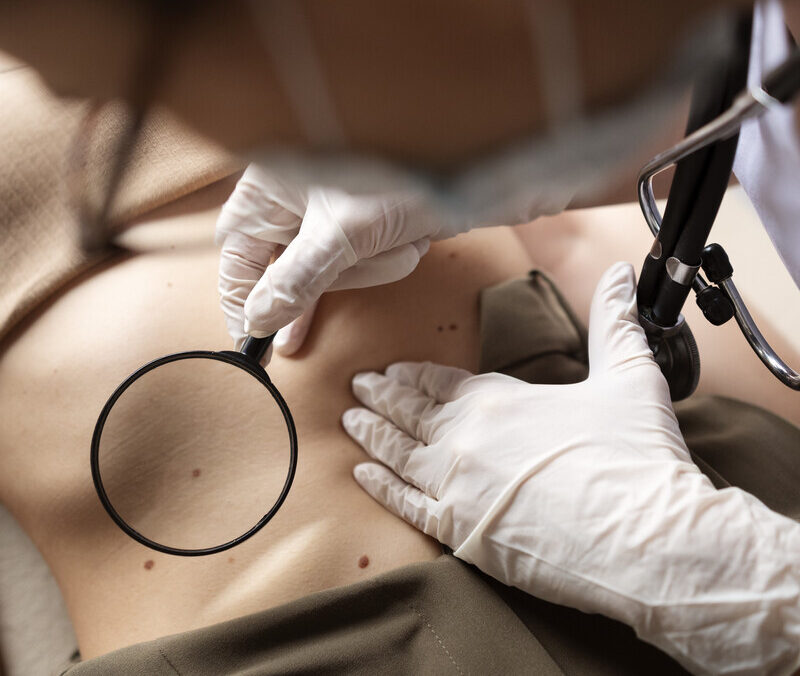 «У меня рак?»: почему появляются родинки и что делать, если их много – ответ дерматолога