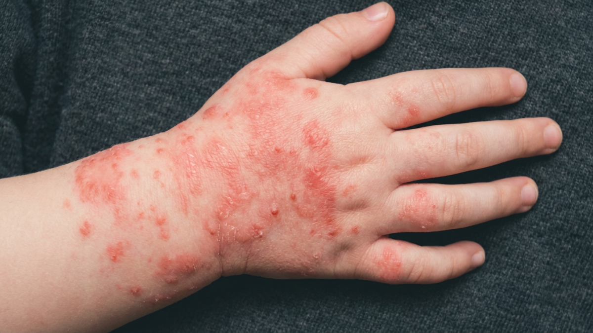 Почему возникает аллергия: ответы на частые вопросы