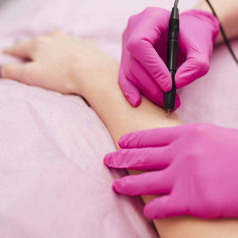 Гладкая кожа на всю жизнь: реально ли это и как на самом деле работает электроэпиляция