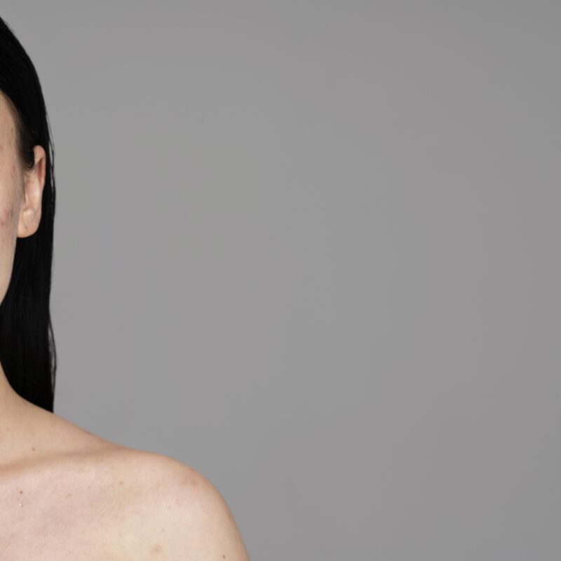 Акне – причины: эксперт привёл топ-6 реальных факторов-провокаторов 