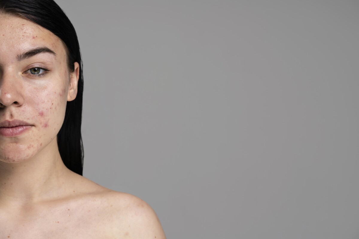 Акне – причины: эксперт привёл топ-6 реальных факторов-провокаторов 